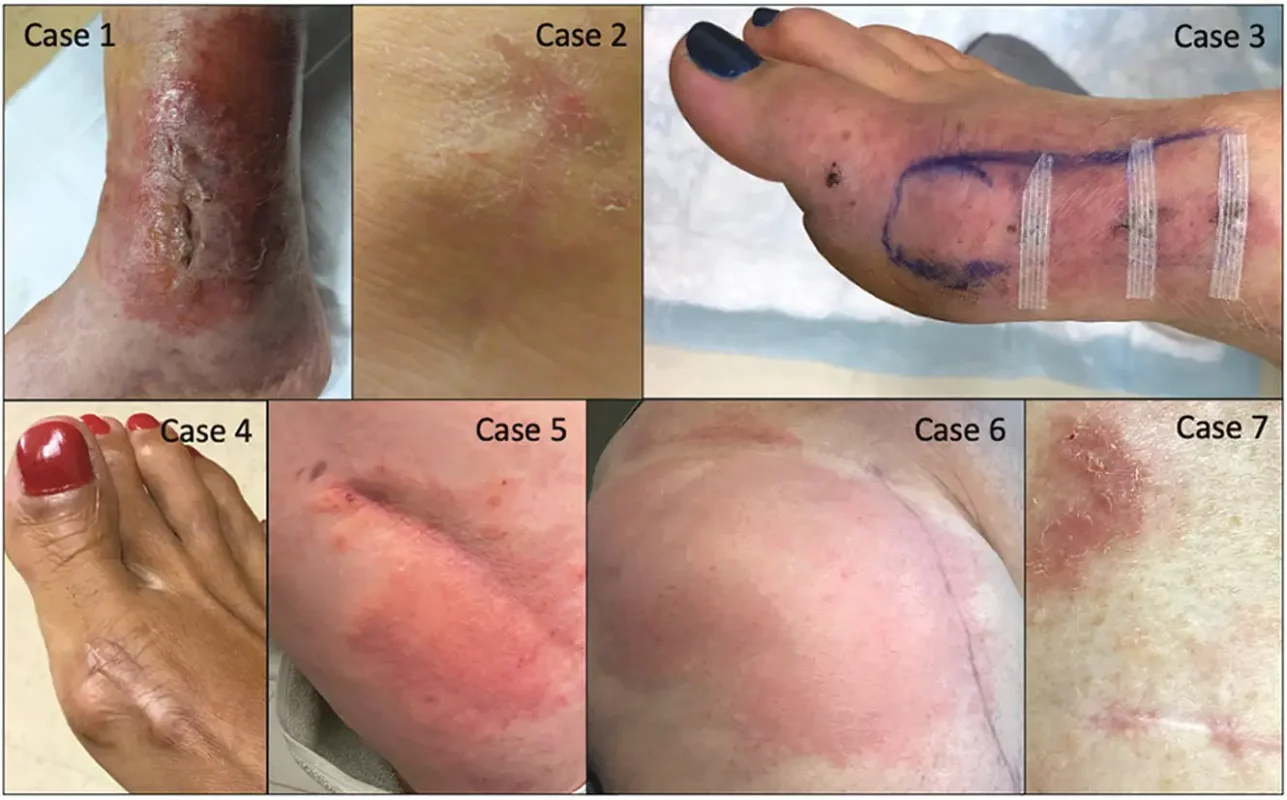 dị ứng do kim loại gây ra