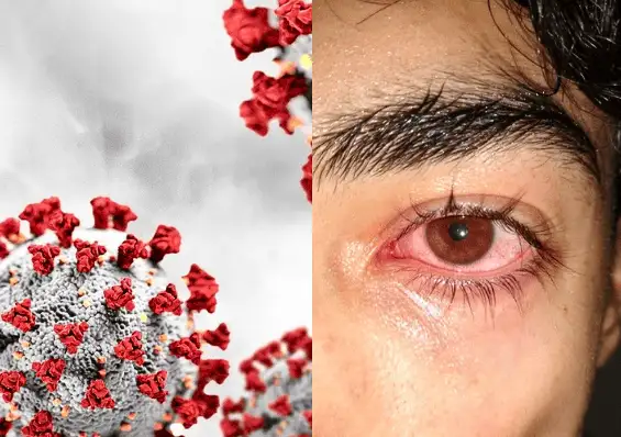   Đau mắt đỏ do virus có thể lây lan rất nhanh cho cộng đồng