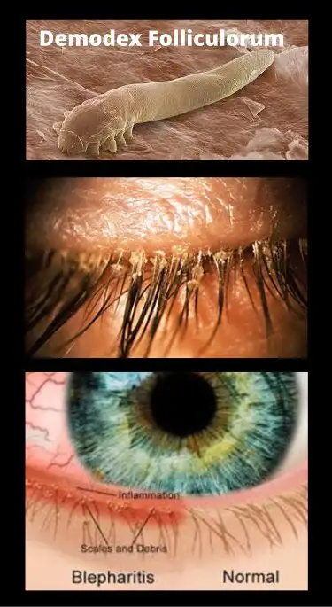 Mạt bụi hoặc mạt lông mi (Demodex).