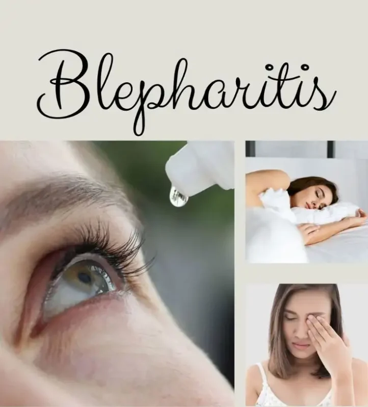 NHỮNG LƯU Ý QUAN TRỌNG KHI ĐIỀU TRỊ VIÊM MÍ MẮT 