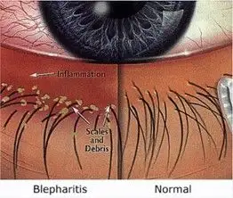 nguyên nhân gây bệnh viêm mí mắt 