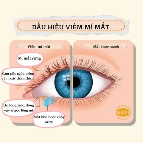 nguyên nhân gây bệnh viêm mí mắt 