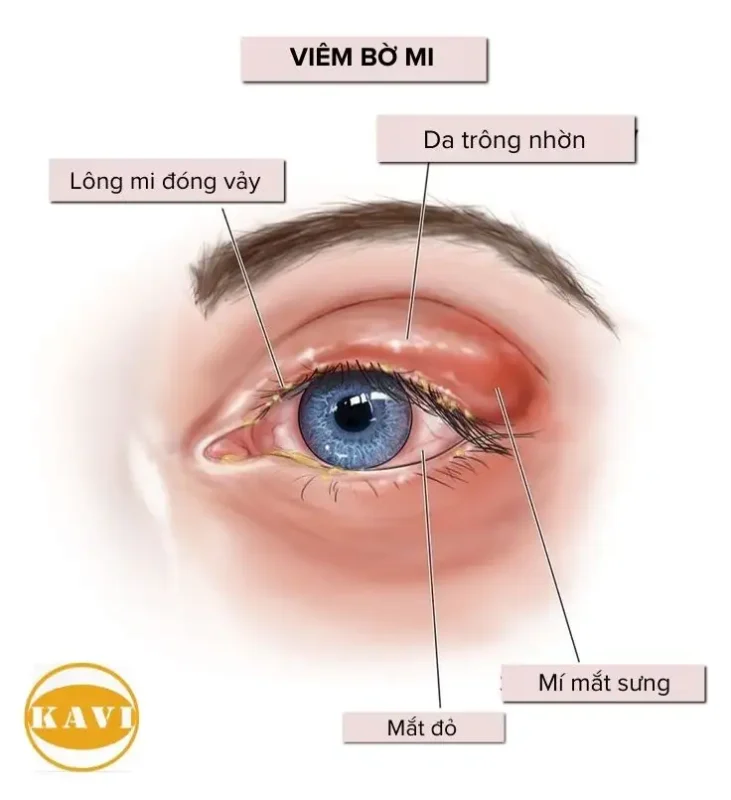 NHẬN BIẾT KHI BỊ VIÊM BỜ MI 