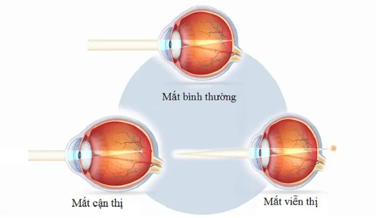 phân biệt cận thị và viễn thị