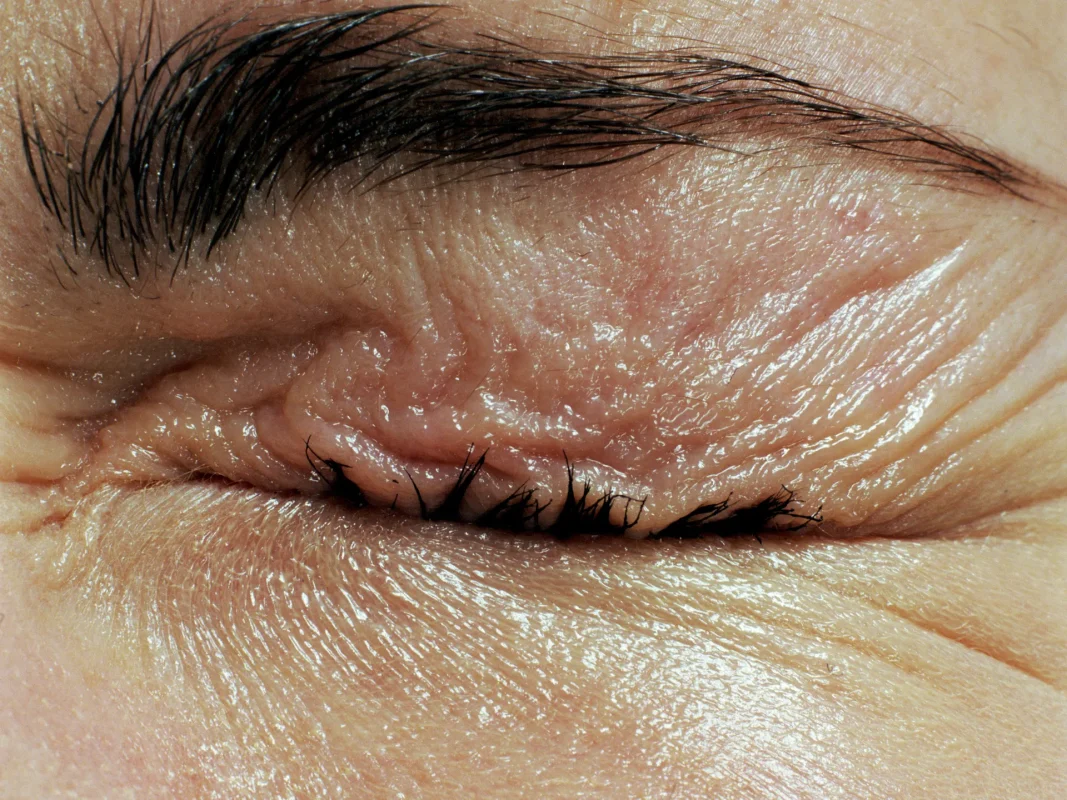 Biến Chứng Do Viêm Mí Mắt
