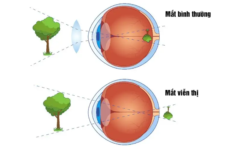 VIỄN THỊ 