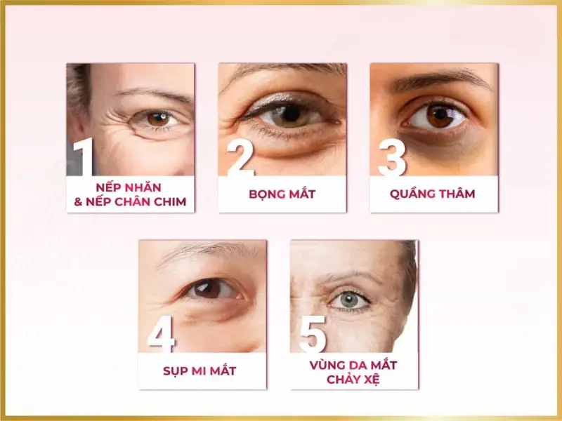 Chống Lão Hóa Mắt: Bí Quyết Giữ Mãi Nét Thanh Xuân Cho Đôi Mắt 4 lao hoa mat 2
