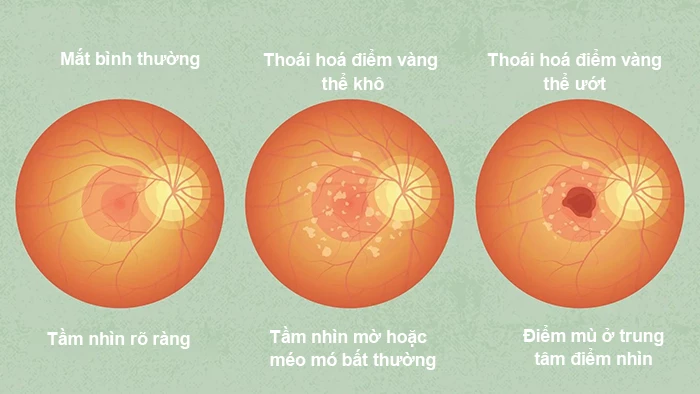 Kính Chống Tia Xanh: Bảo Vệ Mắt Toàn Diện Trong Thời Đại Công Nghệ Số 5 thoai hoa diem vang la gi
