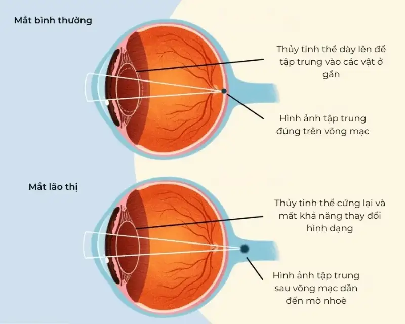 Kính Lão Thị : Tất Tần Tật Từ A-Z 3 Lao thi la gi 1