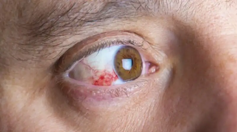 Tác Hại Của Bụi Bẩn Đến Mắt: Nhận Biết, Phòng Tránh & Bảo Vệ Toàn Diện 12 tac hai cua bui min 4