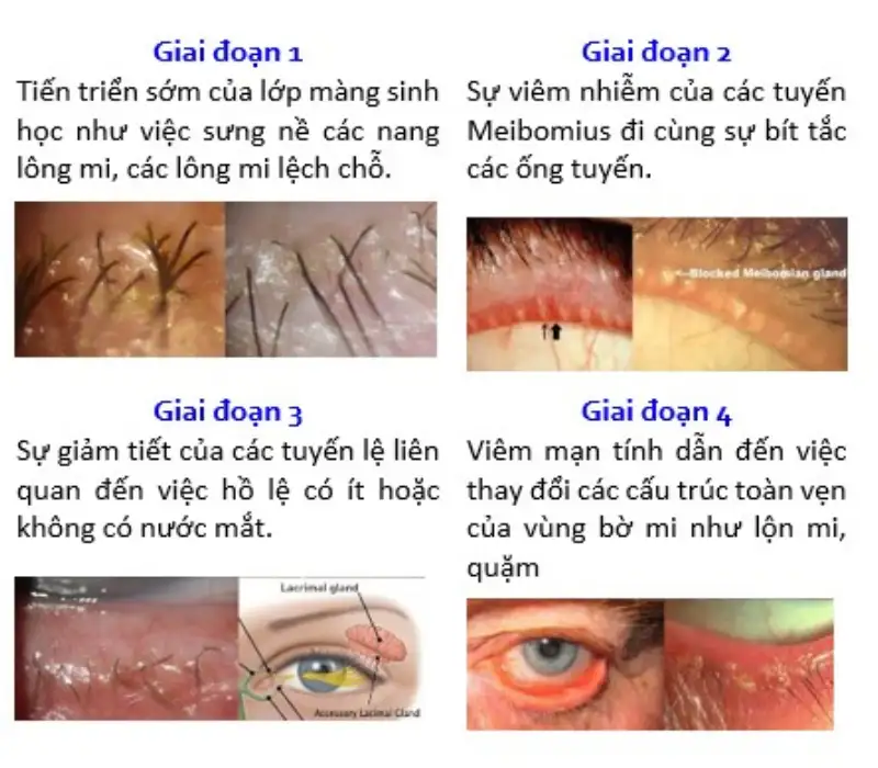 Tác Hại Của Bụi Bẩn Đến Mắt: Nhận Biết, Phòng Tránh & Bảo Vệ Toàn Diện 8 tac hai cua bui min