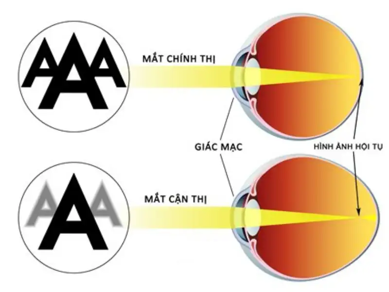 do can cua mat la gi