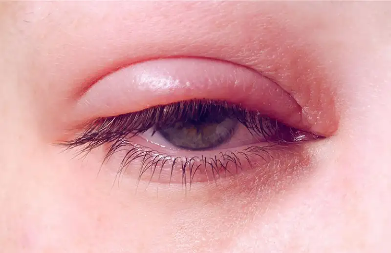 cac benh mat van phong 5