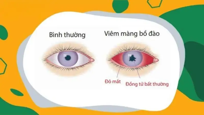 cac benh mat van phong 6